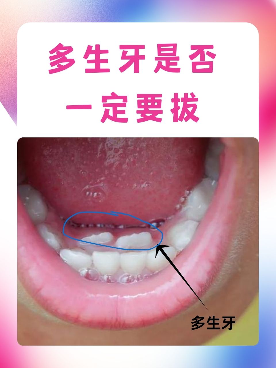 多生牙是否一定要拔  在口腔健康的话题中,多生牙无疑是一个令人关注