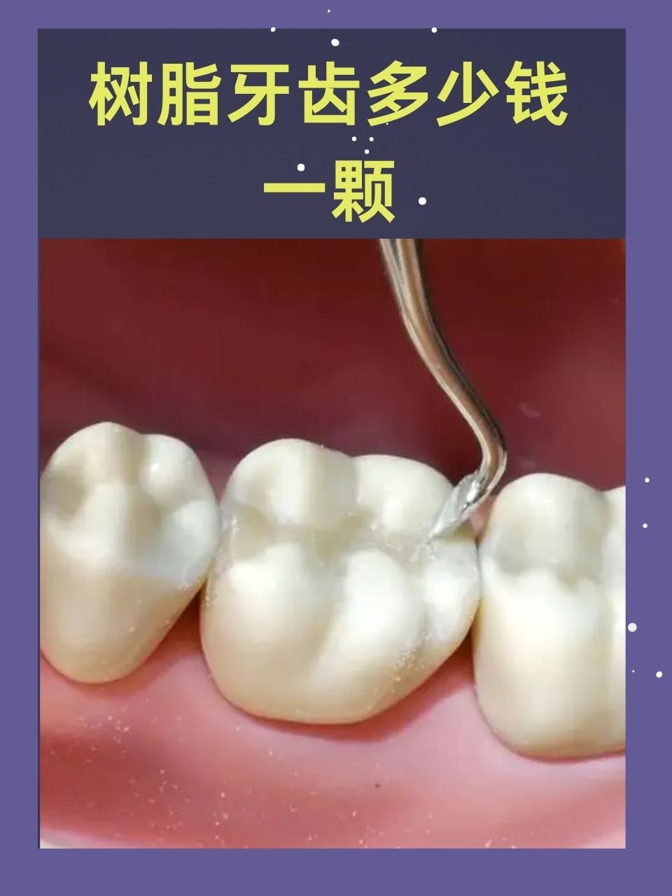 口腔医生来科普:树脂牙齿多少钱一颗?