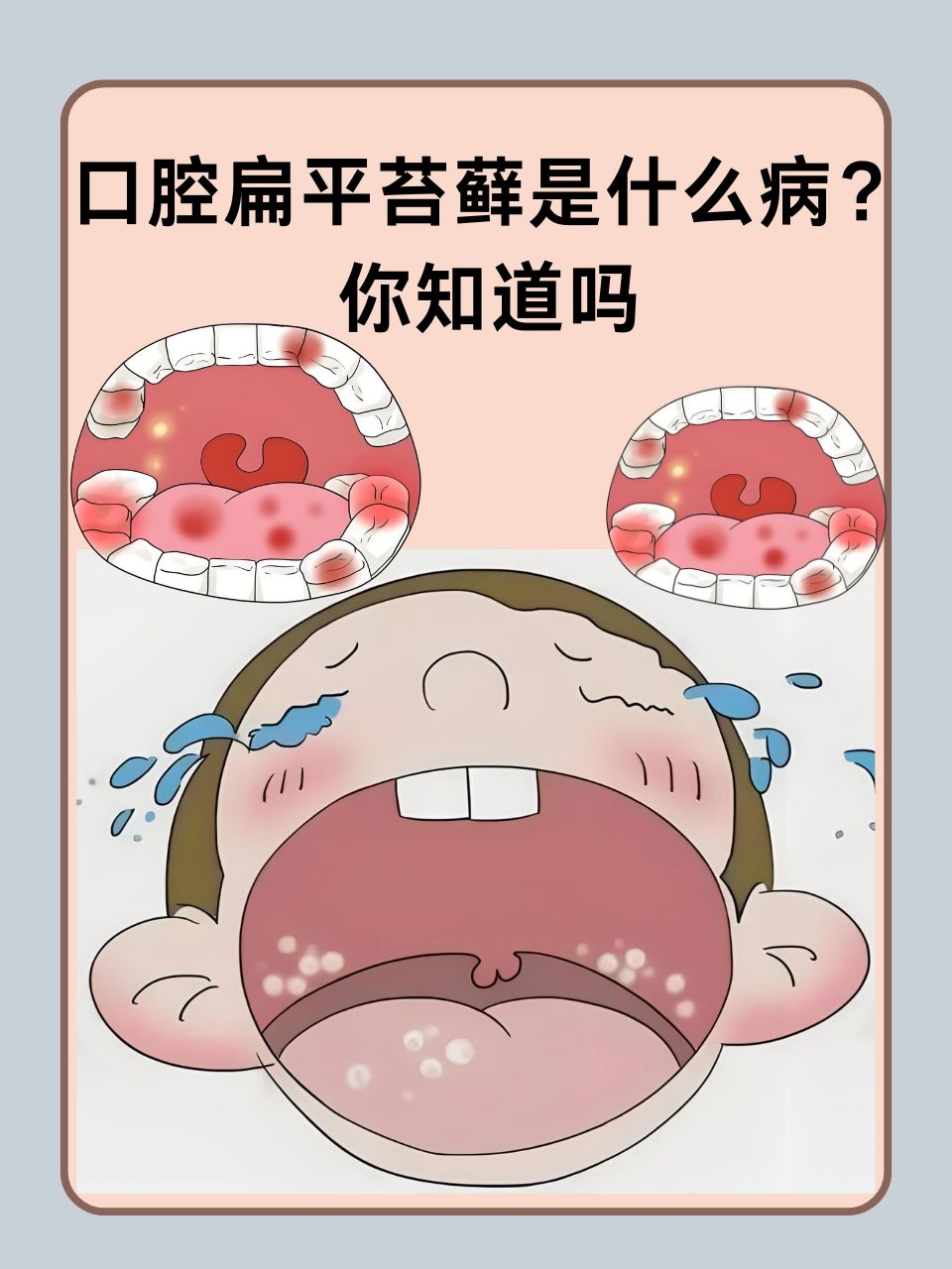 你知道吗  口腔扁平苔藓作为一种常见的口腔黏膜疾病,虽然并不总是