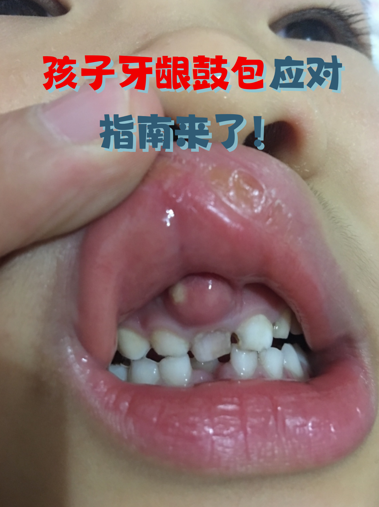 发现孩子牙龈肿起小包,哭闹喊疼不肯吃饭?到底是长牙还是发炎?