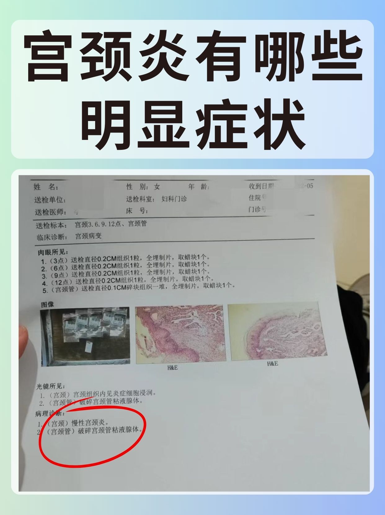 女性的生殖健康一直备受关注,而宫颈炎是一种较为常见的妇科疾病