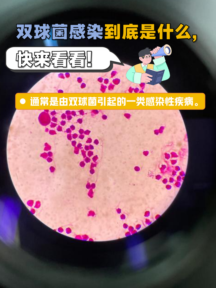 疾病诊断镜下淡粉色伞状细菌是什么球杆菌感染是什么意思肺炎双球图片