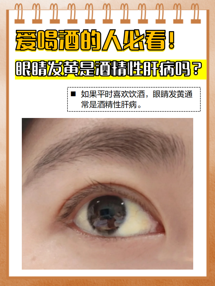 眼睛发黄是酒精性肝病吗?