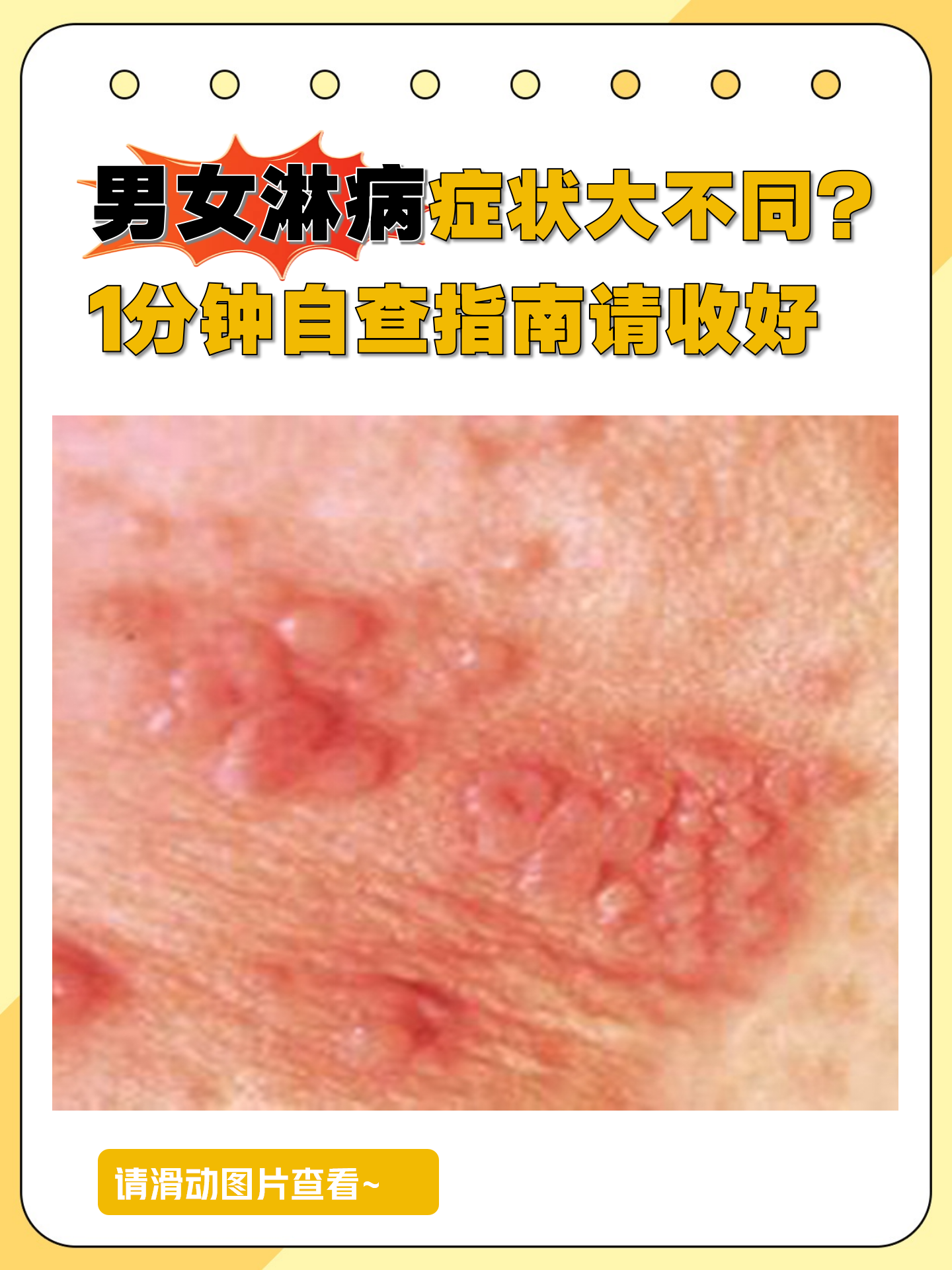 淋病症状男女差异超乎想象,有人疼痛难忍,有人毫无察觉