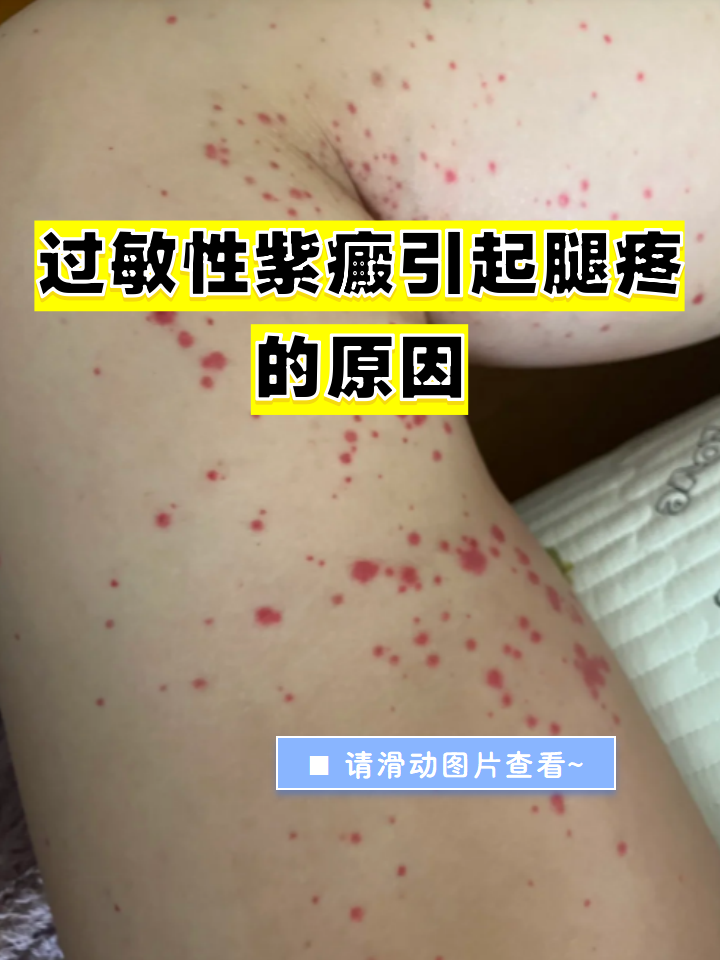 为什么身上会出现淤青