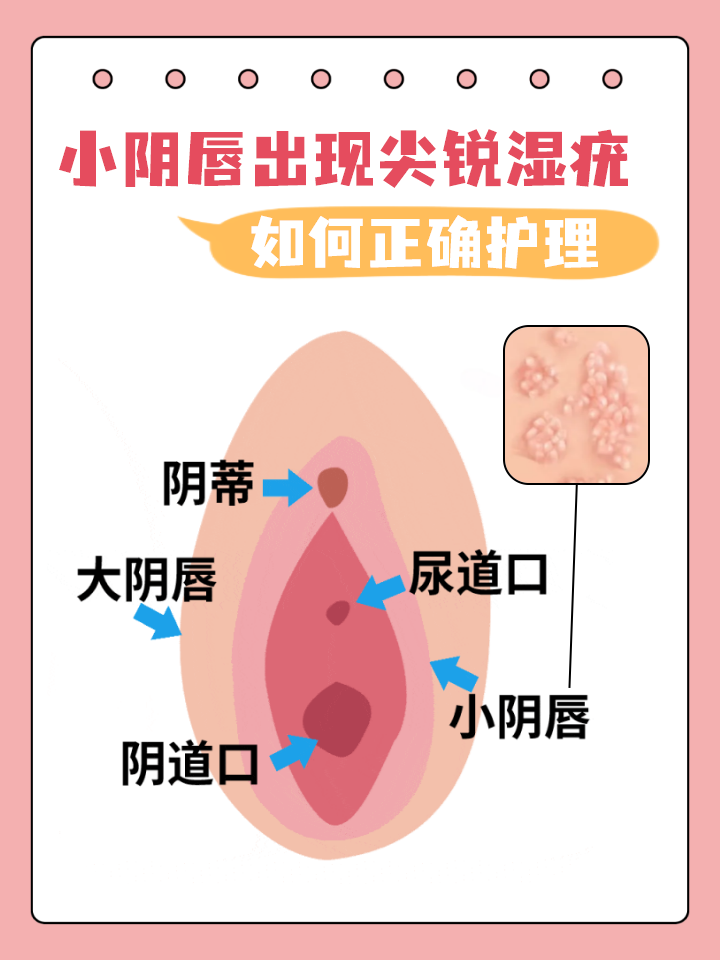 先别慌!这可能是尖锐湿疣在作祟