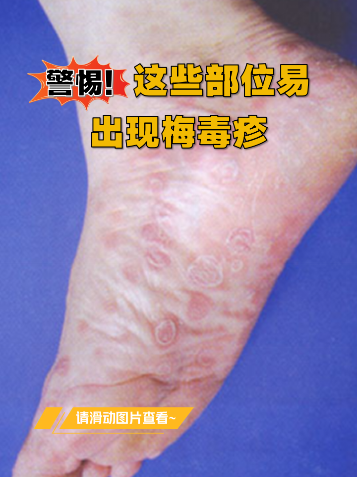 这些部位易出现梅毒疹