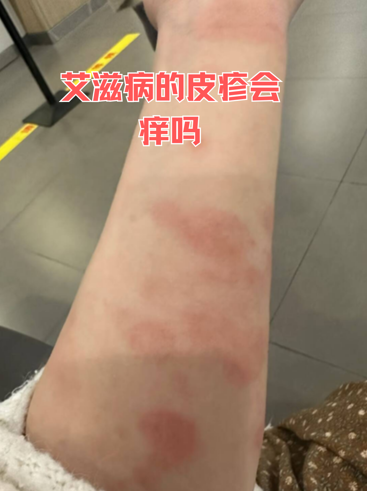 艾滋病引起的皮疹确实可能伴随瘙痒感,但具体