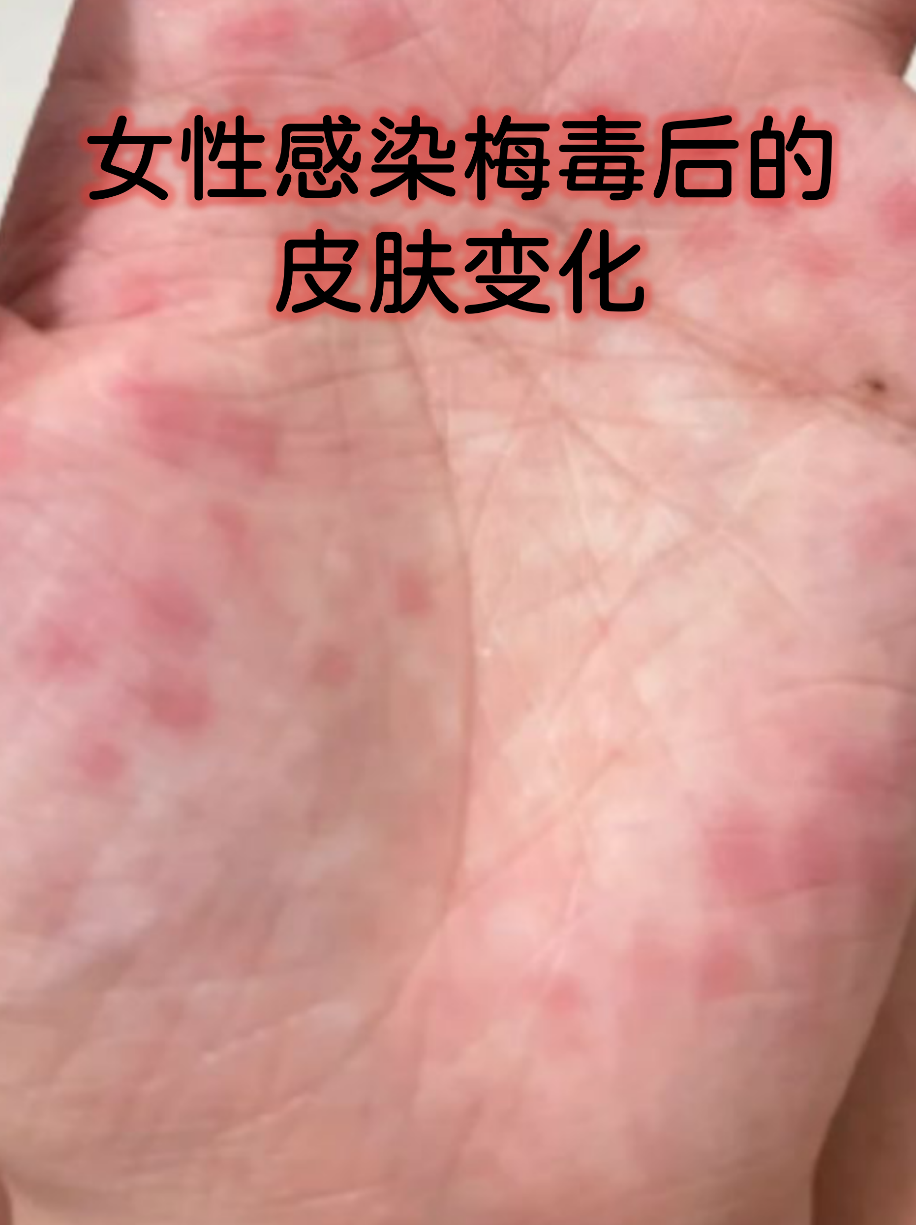 女性感染梅毒后的皮肤变化