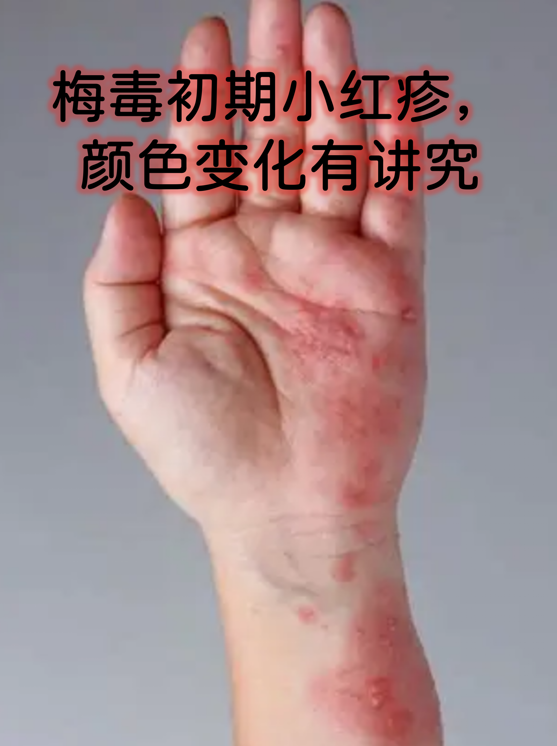 梅毒初期小红疹,颜色变化有讲究