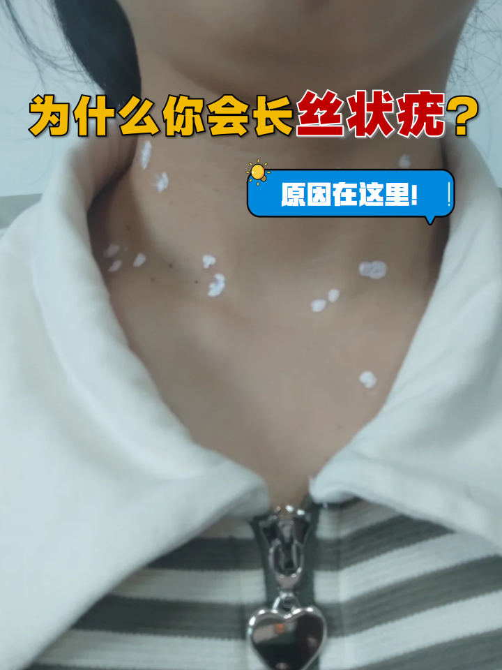 为什么会长瘊子原因是什么为什么在线 为什么会长瘊子原因是什么为什么在线