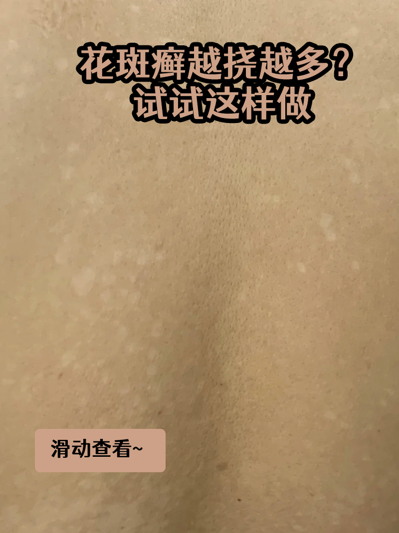 花斑癣图片怎么治疗花斑癣是怎么染上的花斑癣怎么根治花斑癣图片危害
