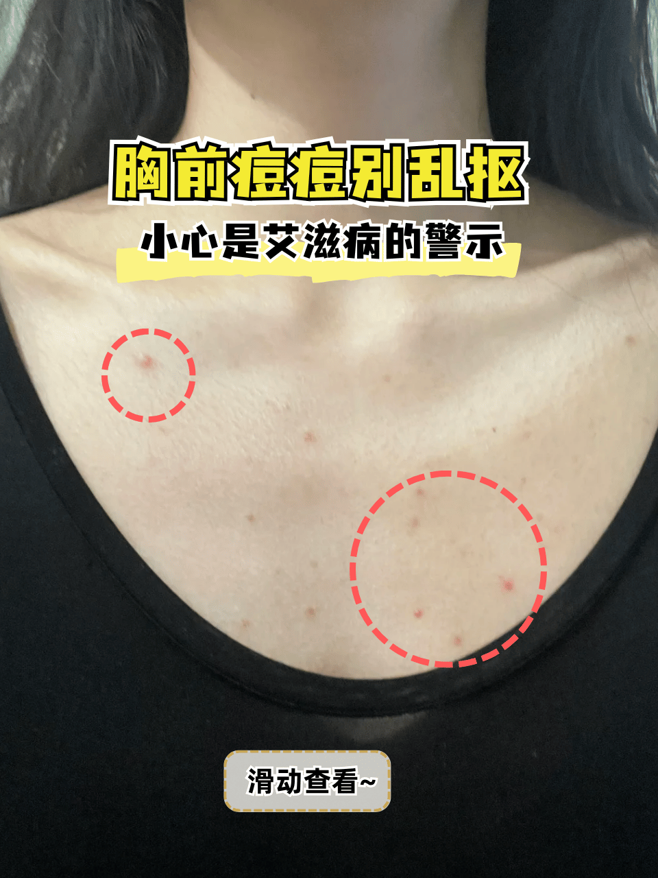 胸前痘痘别乱抠,小心是艾滋病的警示