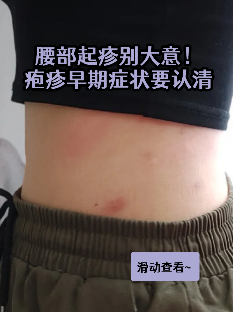 疱疹早期症状要认清