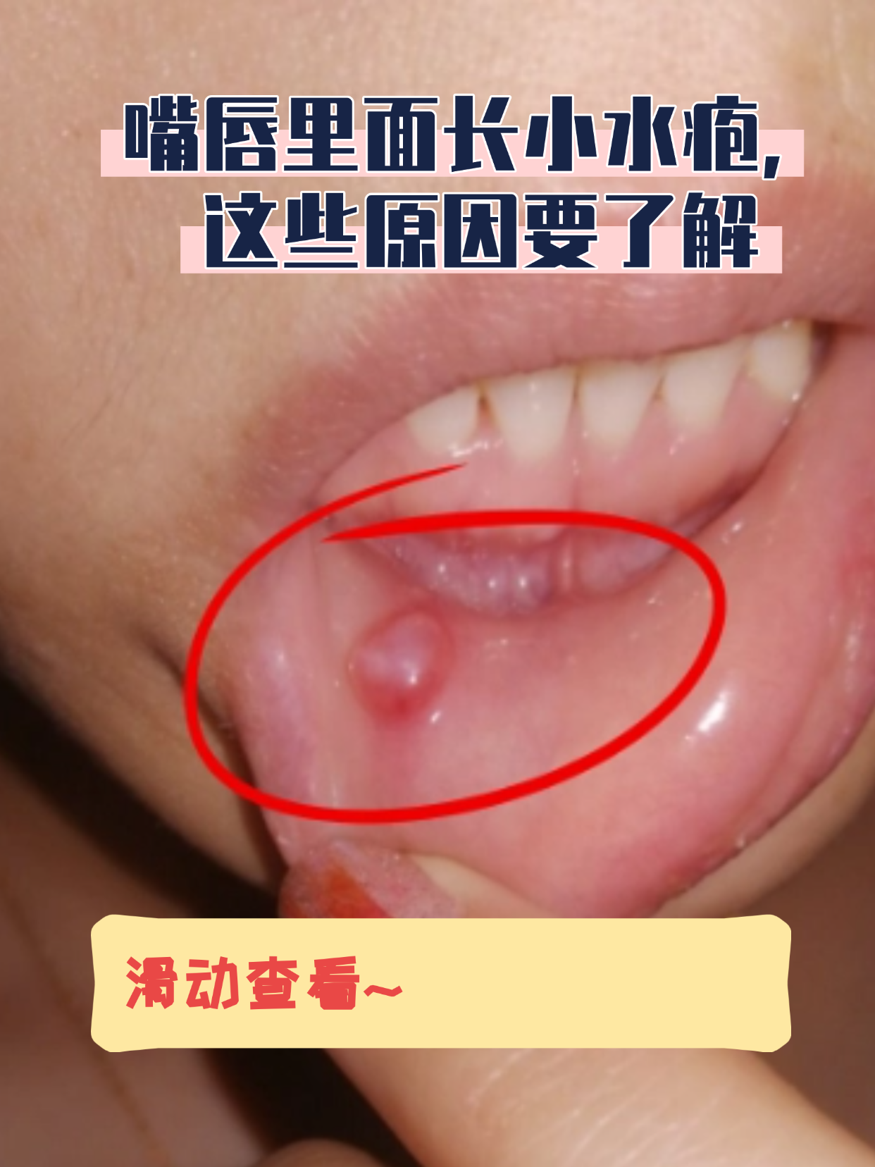 嘴唇里面长小水疱,这些原因要了解