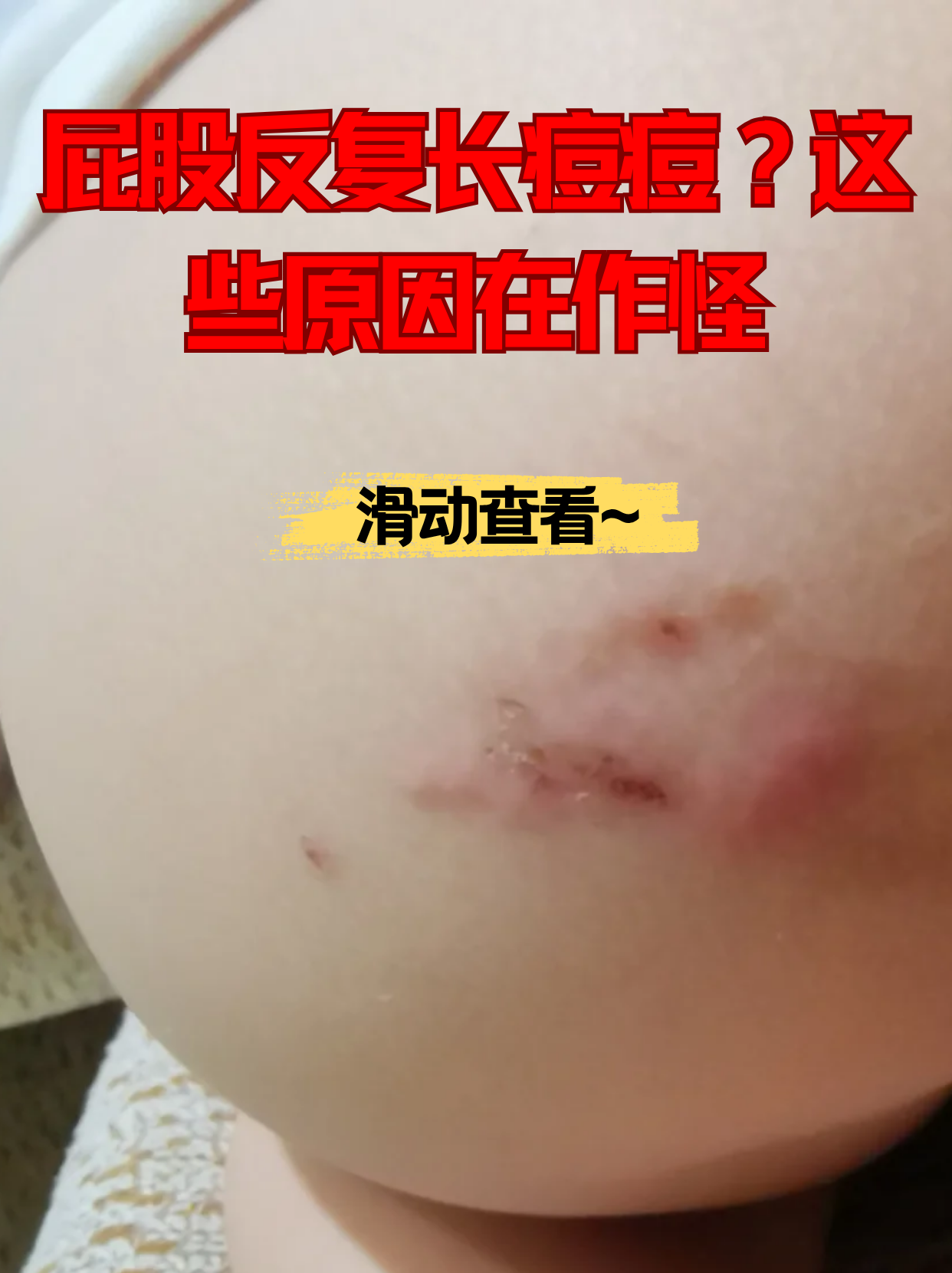 屁股反复长痘痘?