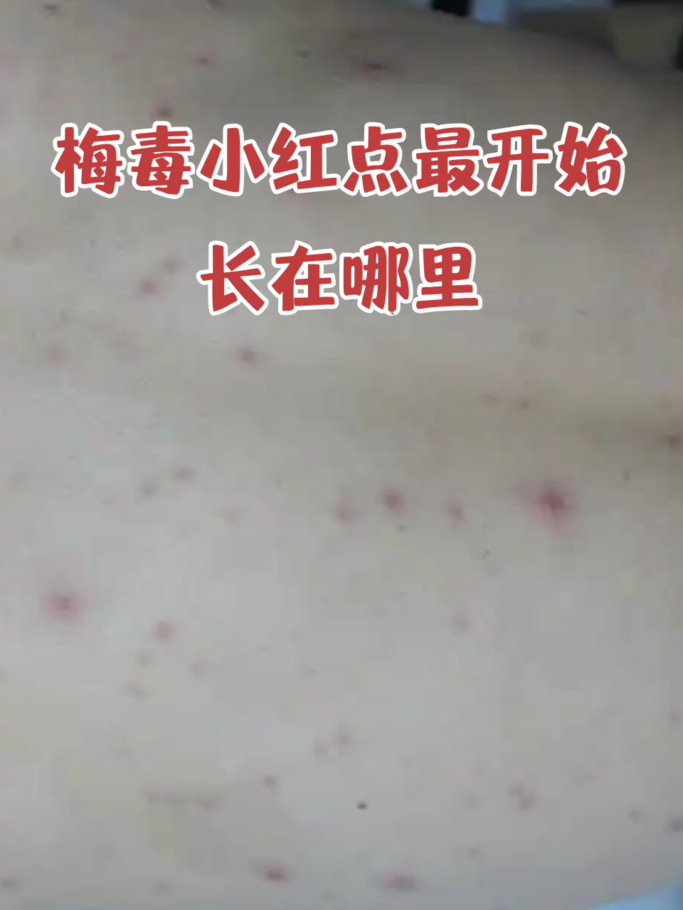 梅毒小红点最开始长在哪里