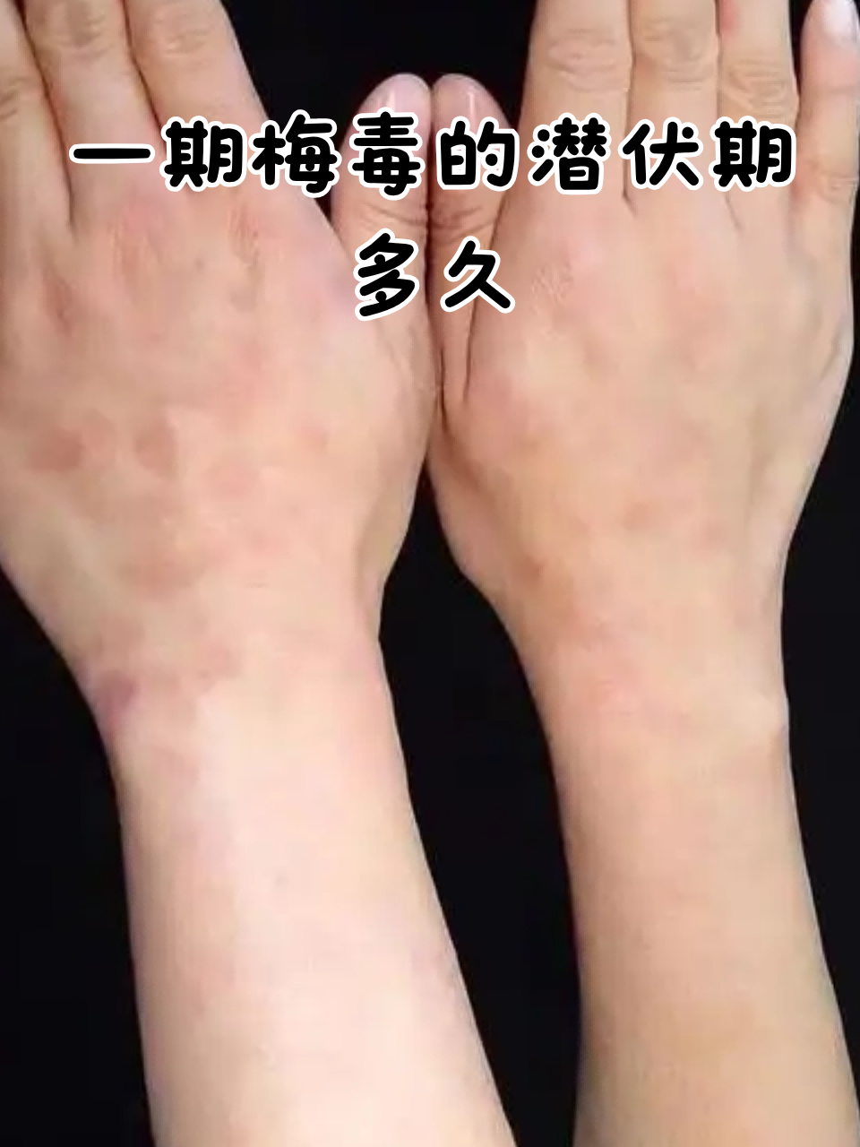 梅毒的潜伏期通常在感染后10