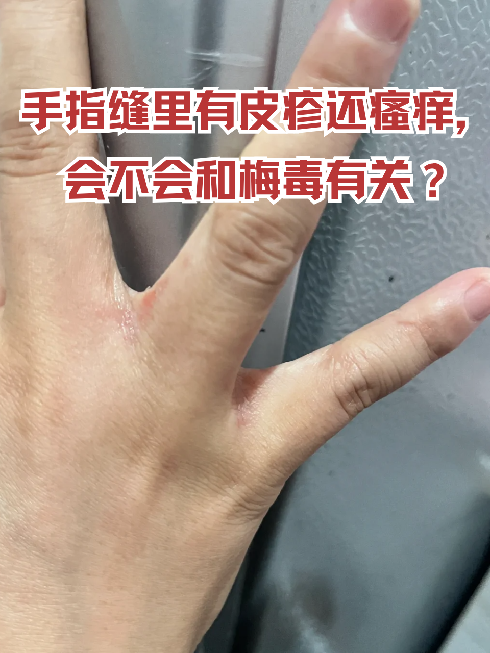 夏季潮湿环境下,这类症状更常见于接触性皮炎或汗疱疹,不过了解梅毒的