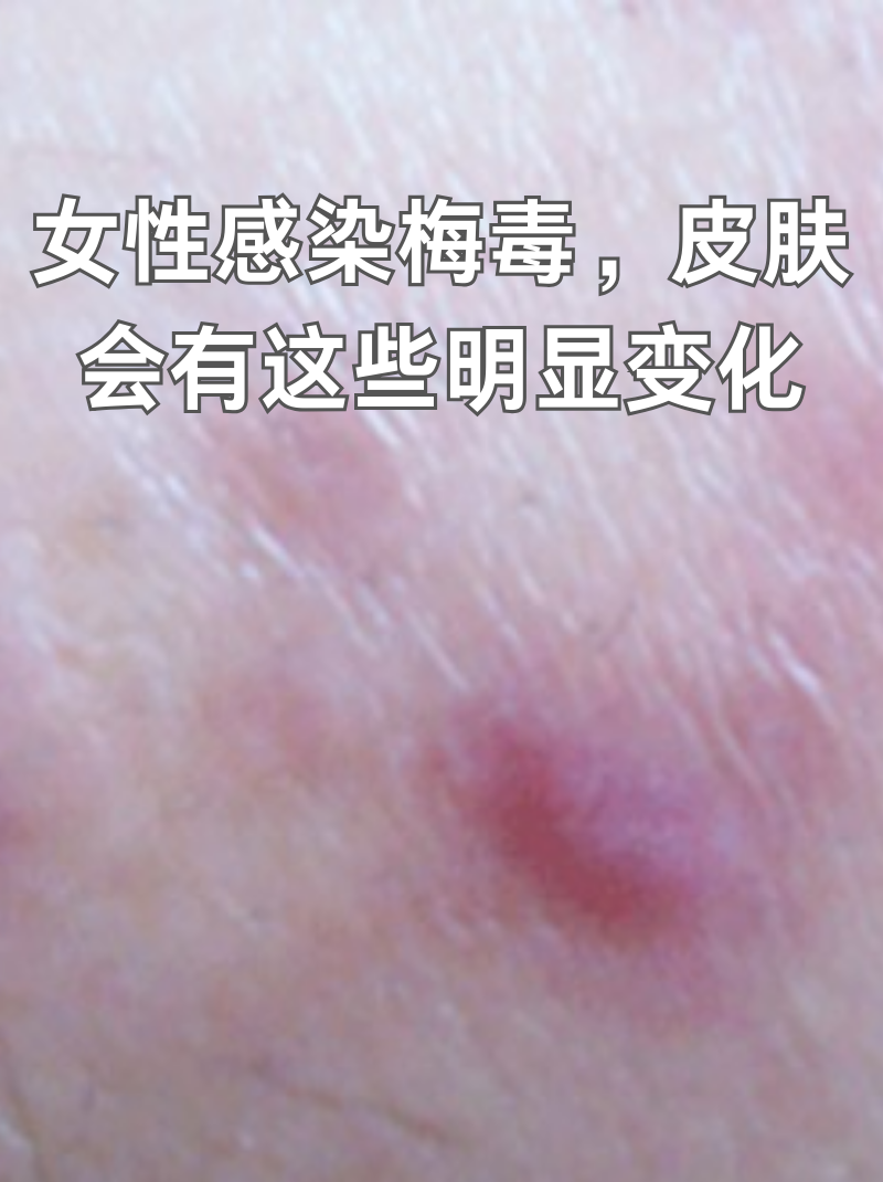 女性感染梅毒,皮肤会有这些明显变化