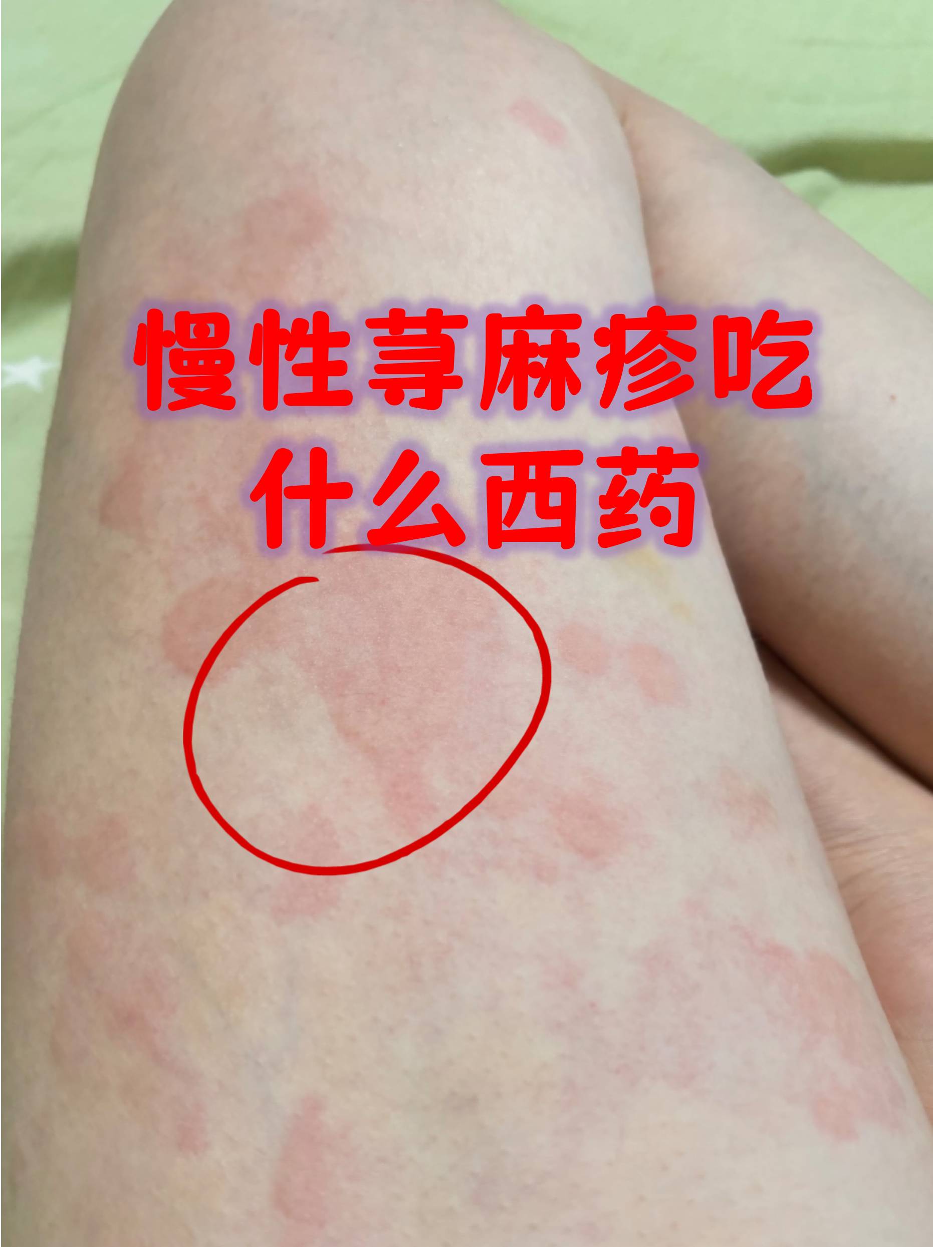 荨麻疹反复发作让人抓狂,慢性荨麻疹更是持久
