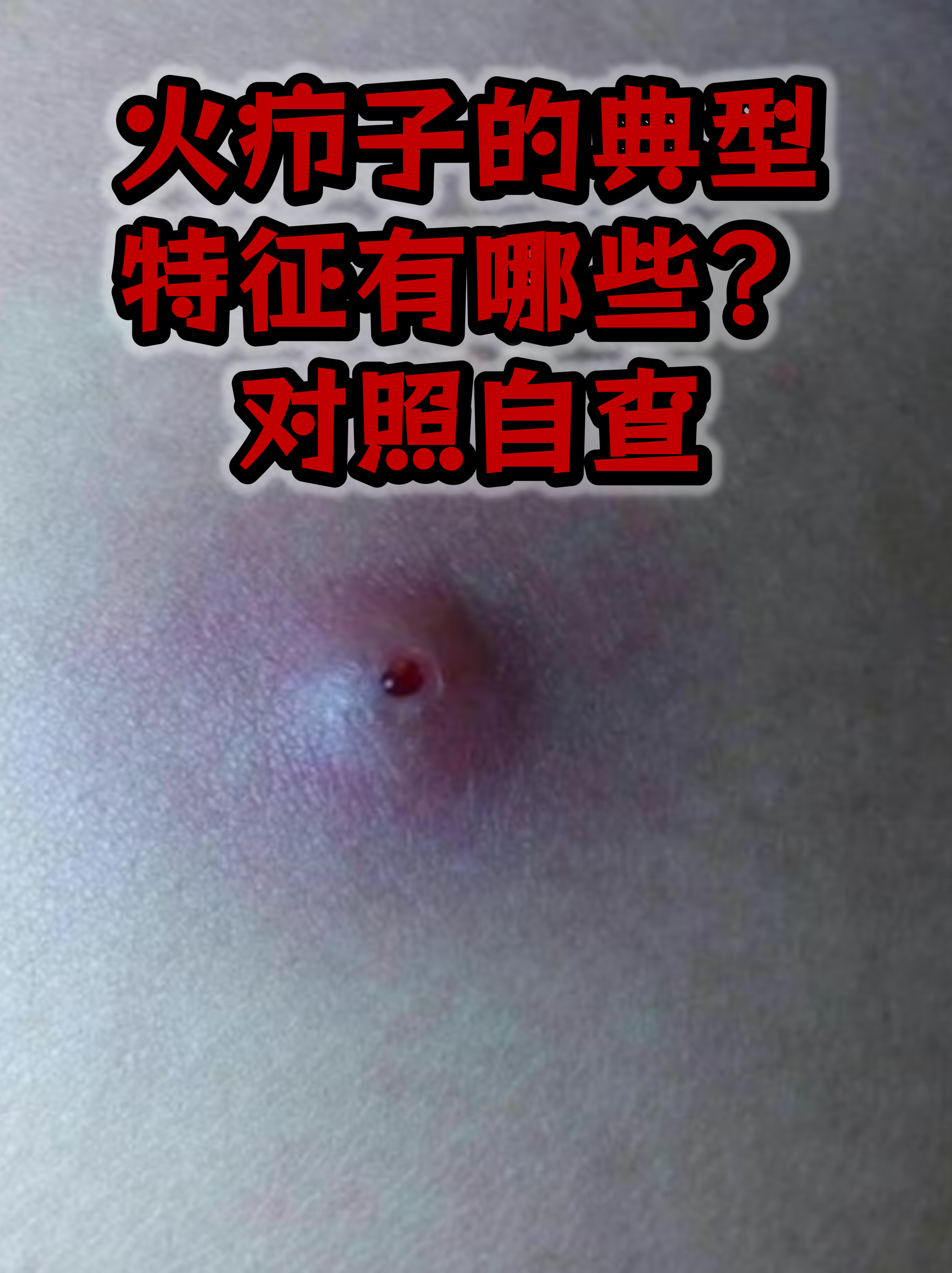 对照自查  火疖子是毛囊和周围组织被细菌感染后形成的急性化脓性炎症