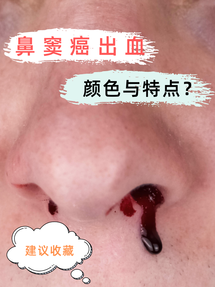鼻窦癌出血:颜色与特点的奇妙呈现 鼻窦癌,听起来就让人心头一紧
