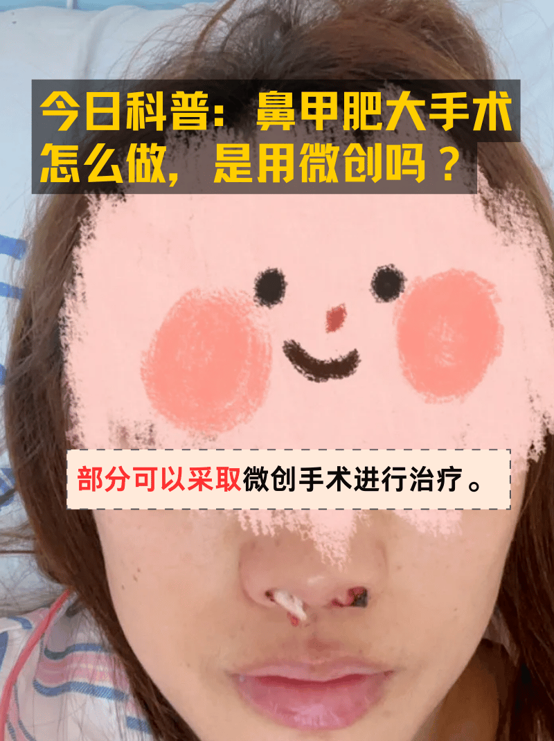 今日科普:鼻甲肥大手术怎么做,是用微创吗?