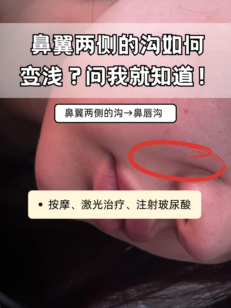 鼻翼两侧的沟一般指鼻唇沟,通常由衰老,皮肤松弛或脂肪堆积引起
