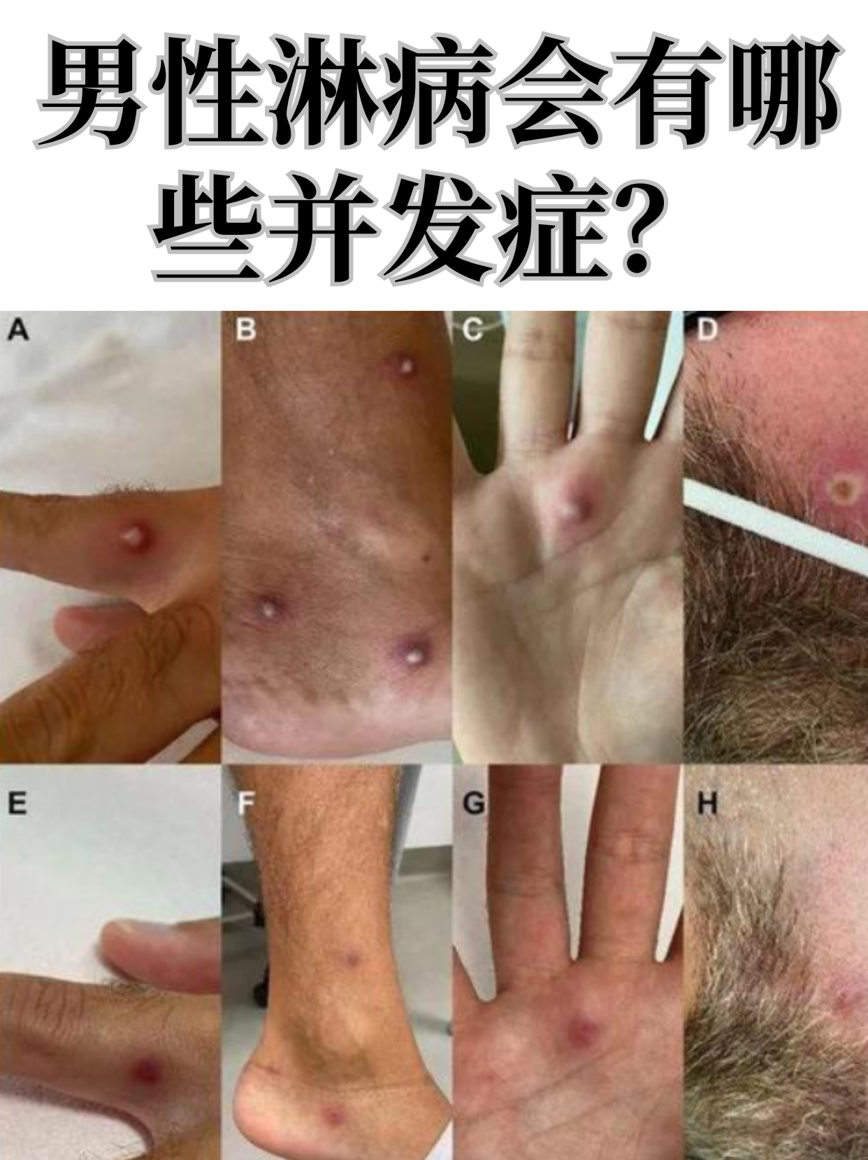 男性淋病若未及时治疗,就像身体里埋了颗定时炸弹,可能引发一系列