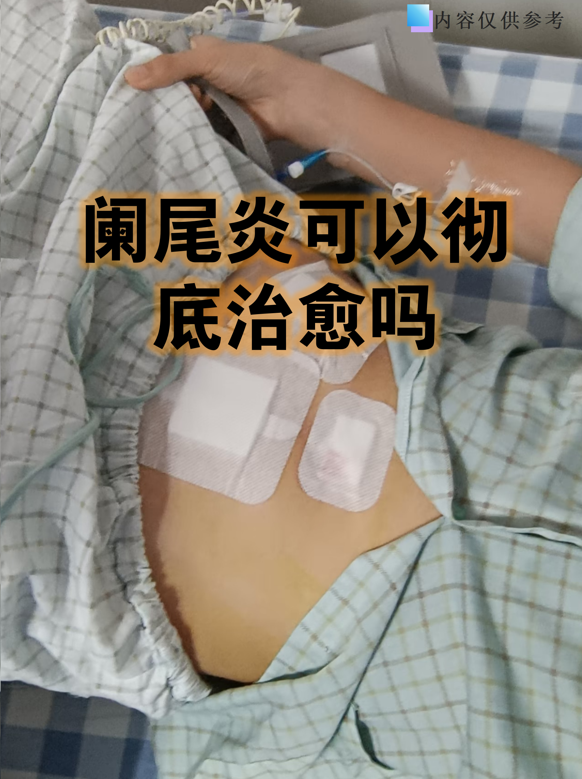阑尾炎可以彻底治愈吗