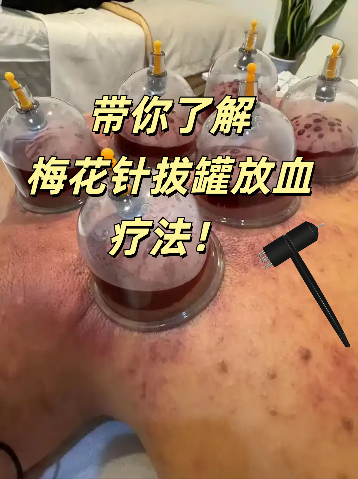 放血针=放血针灸有什么好处