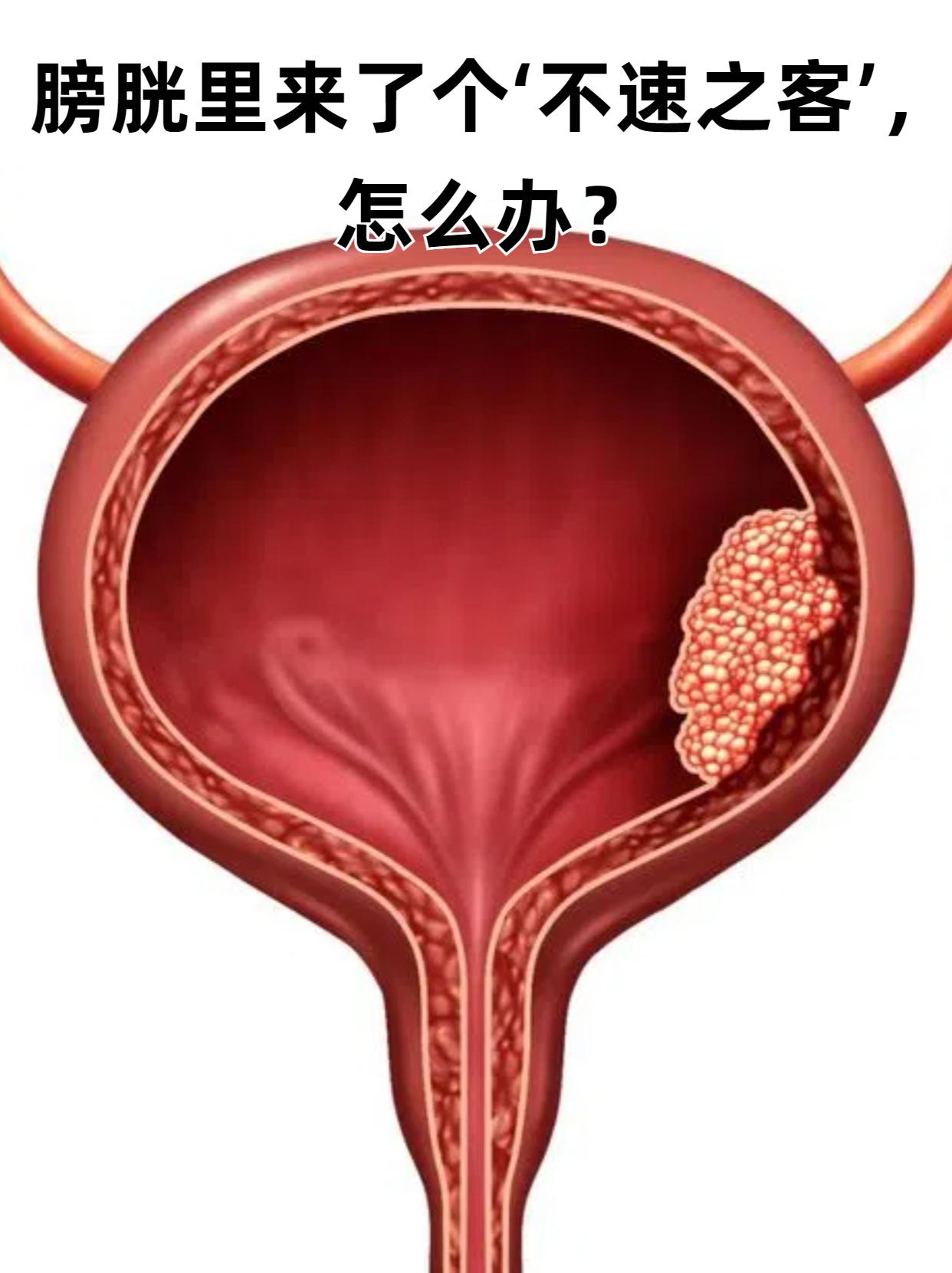 膀胱癌的发病原因尚未完全明确,可能与遗传因素,环境因素,饮食因素等