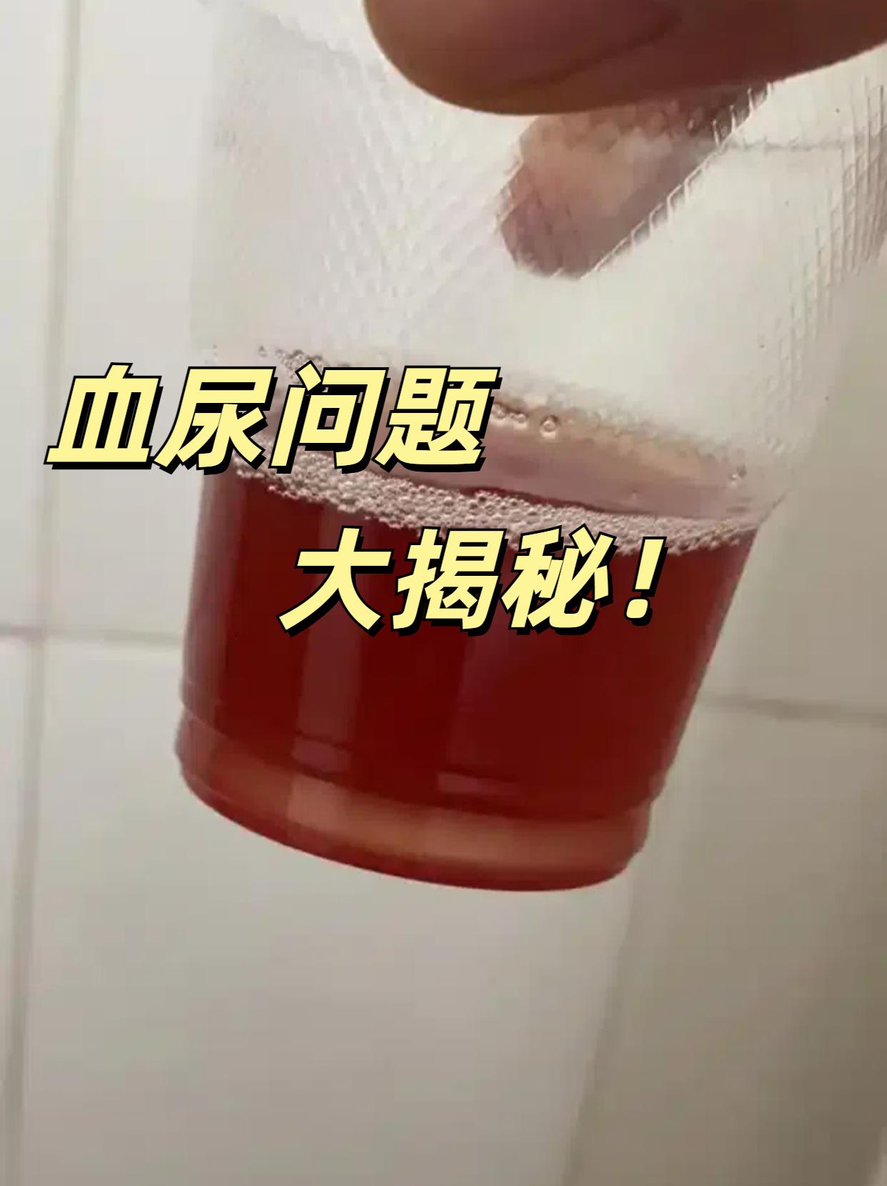 包括 血尿什么颜色才算尿血图片血尿是什么颜色及图片尿液发红褐色