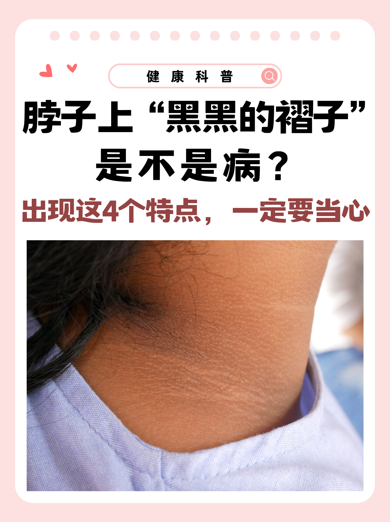 脖子上"黑黑的褶子"是不是病?