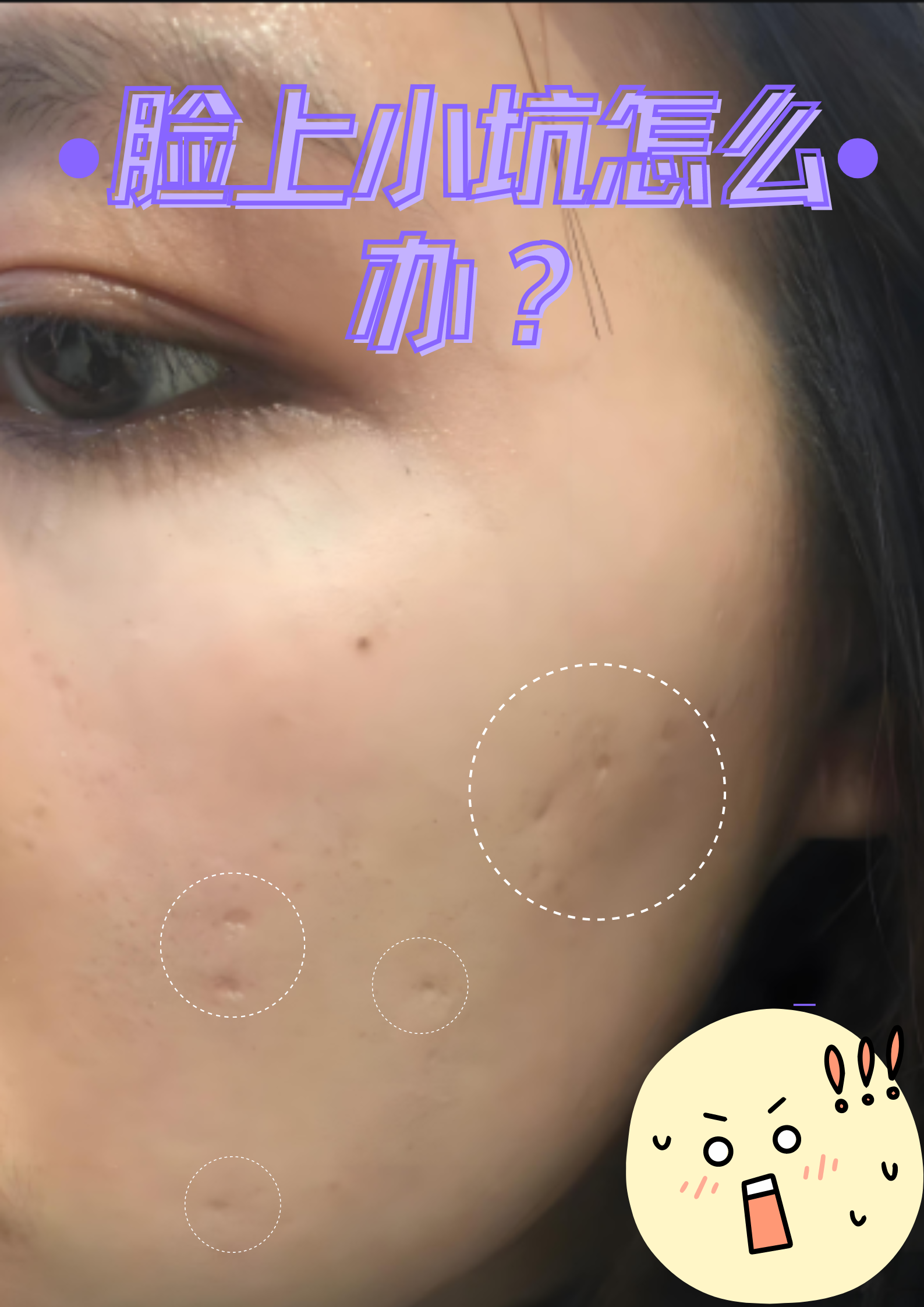 如青春痘留下的痘坑,外伤后的疤痕或是先天性的皮肤凹陷等