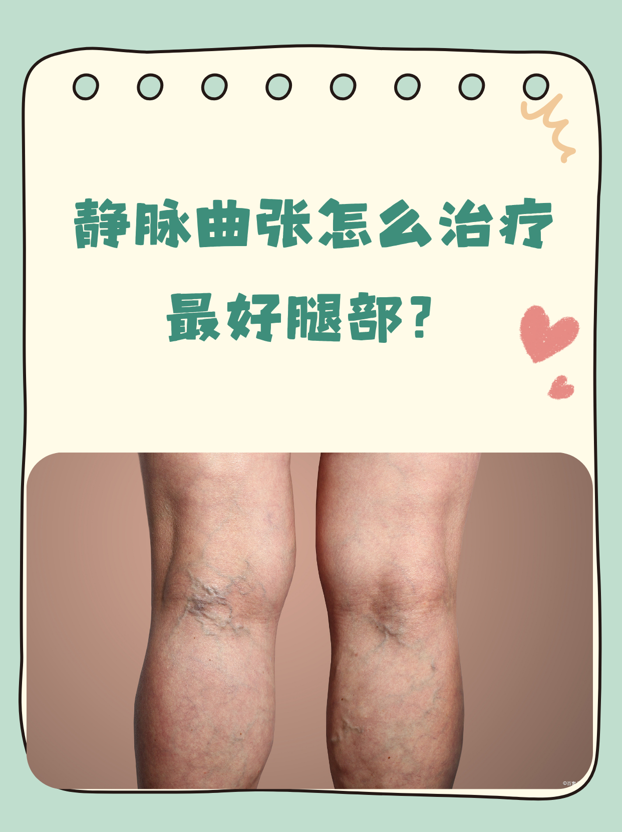 静脉曲张的治疗方法因人而异,但以改善血液循环,减轻症状和防止恶化