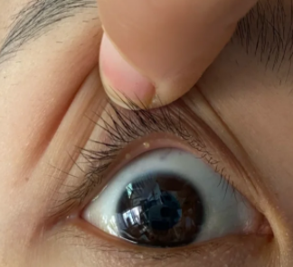 回事  眼睛扒开后发现里面有白色疙瘩,可能由以下原因引起:  结膜结石