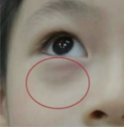 宝宝眼袋发青,可能是由以下几种情况引起的哦: