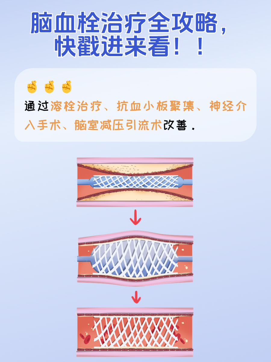 阿替普酶勃林格图片