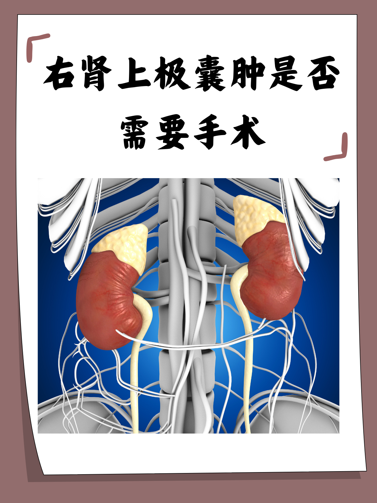 肾上极囊肿,顾名思义,是指位于肾脏上极的囊性肿块