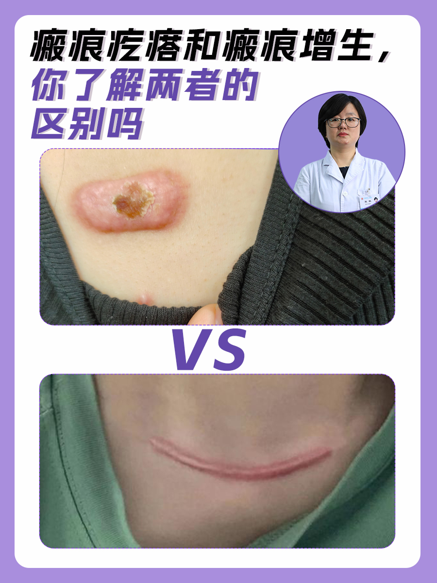 瘢痕疙瘩和瘢痕增生,你了解两者的区别吗