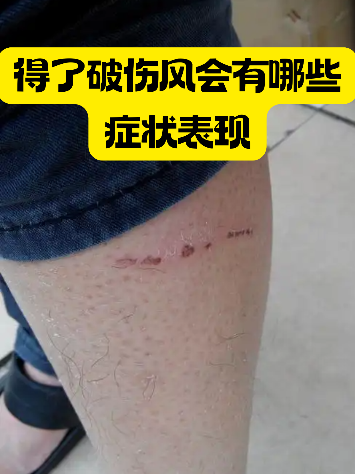 得了破伤风会有哪些症状表现