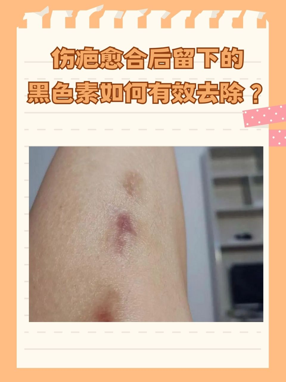 为大家提供一些 疤痕皮肤色素沉着怎么消除伤口愈合后显黑红怎么回事