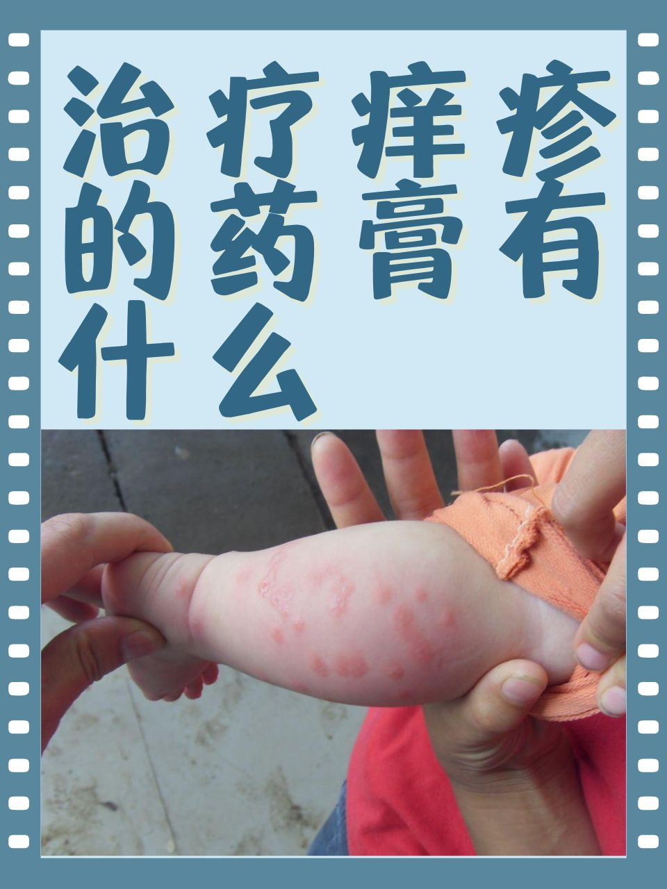 治疗痒疹的药膏有什么