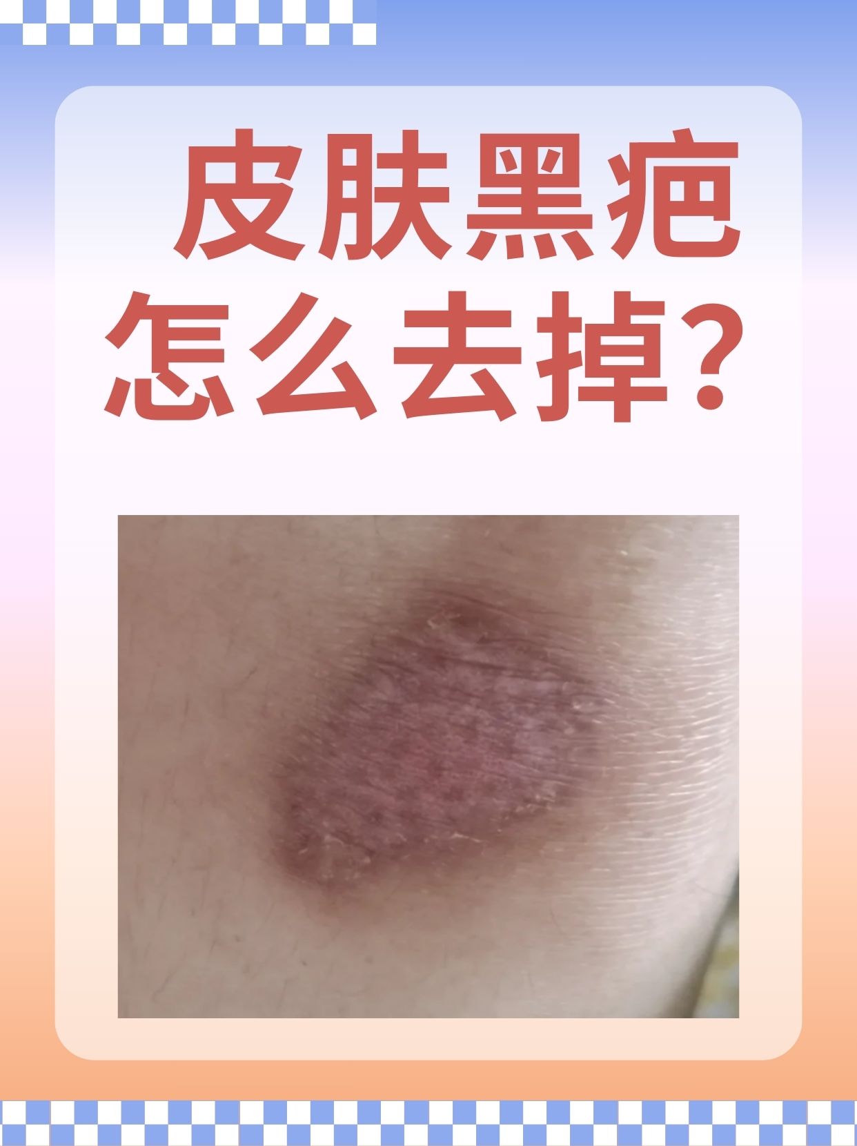 皮肤黑疤怎么去掉 皮肤黑疤是许多人都面临的困扰