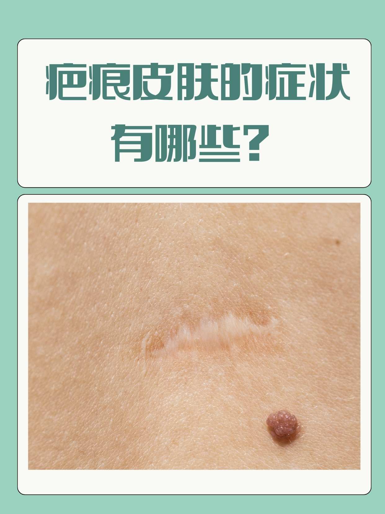 什么皮肤病会留下疤痕