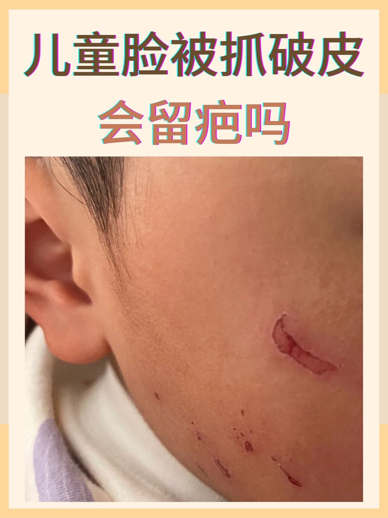 儿童脸被抓破皮会留疤吗 在日常生活中,我们经常会遇到儿童意外受伤的
