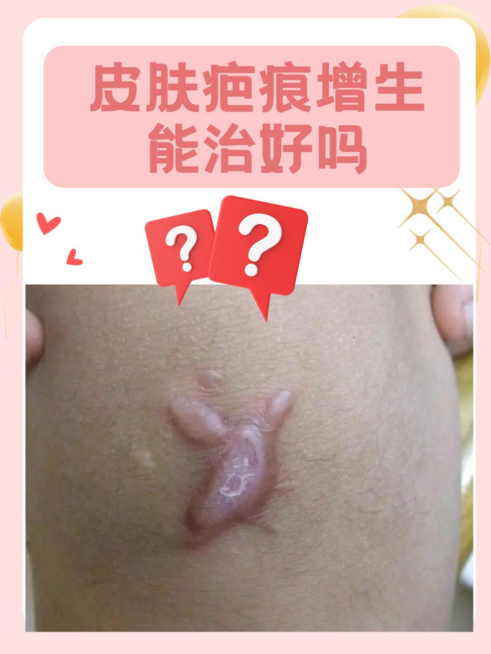 皮肤疤痕增生能治好吗