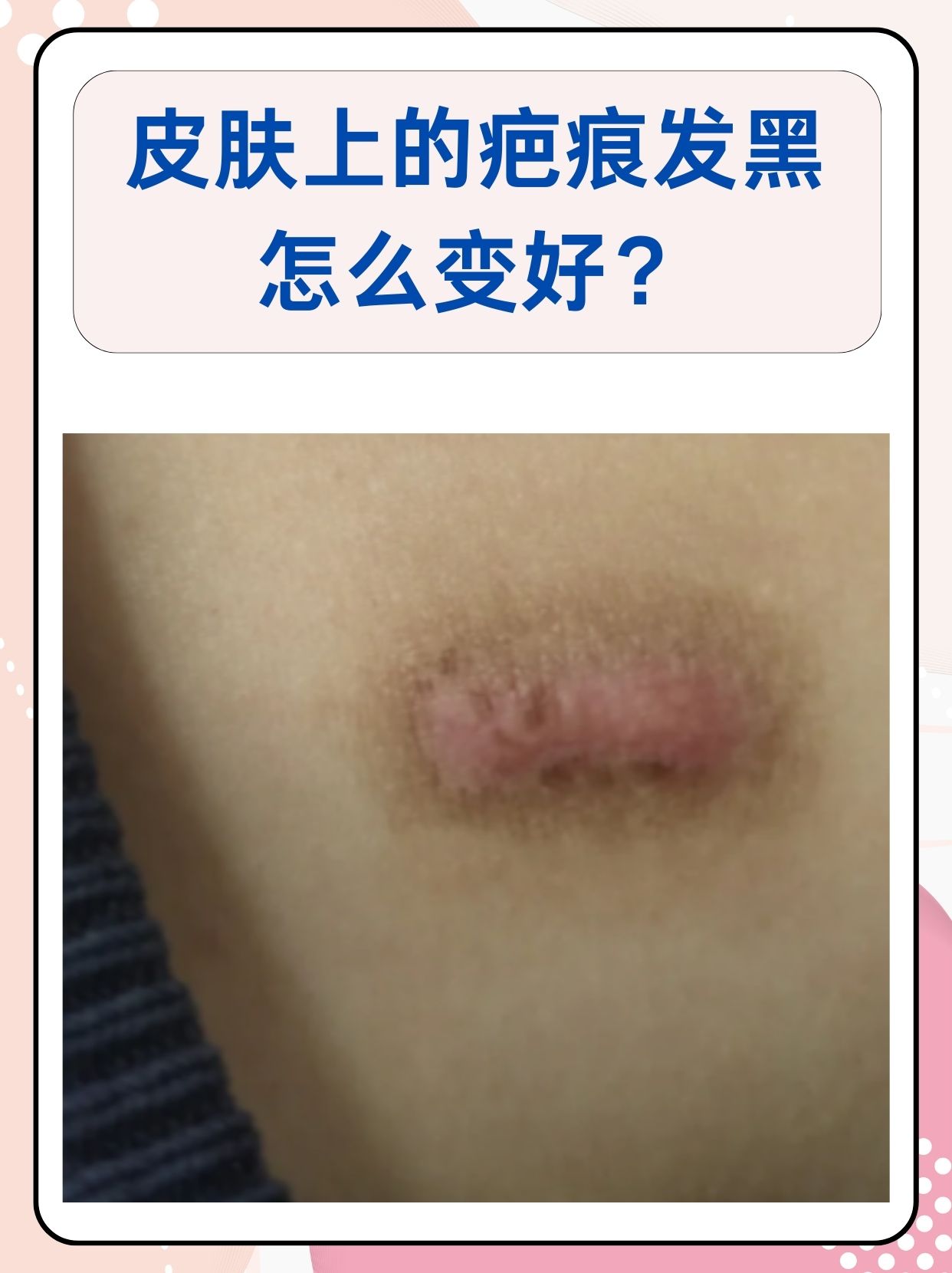 皮肤上的疤痕发黑常常让人困扰,影响美观.